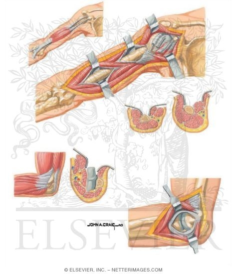 Watermarked preview of unlabeled image: Surgical Approaches to the Upper Arm and Elbow