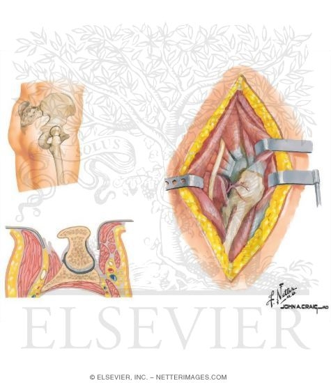 Watermarked preview of unlabeled image: Surgical Approaches of the Thigh and Hip