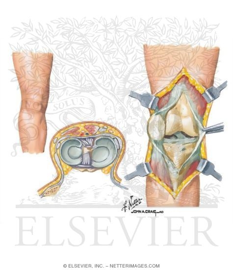 Watermarked preview of unlabeled image: Surgical Approaches to the Leg and Knee
