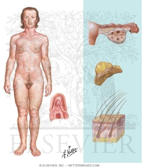 Watermarked preview of unlabeled image: Clinical Manifestations of Hyperandrogenism