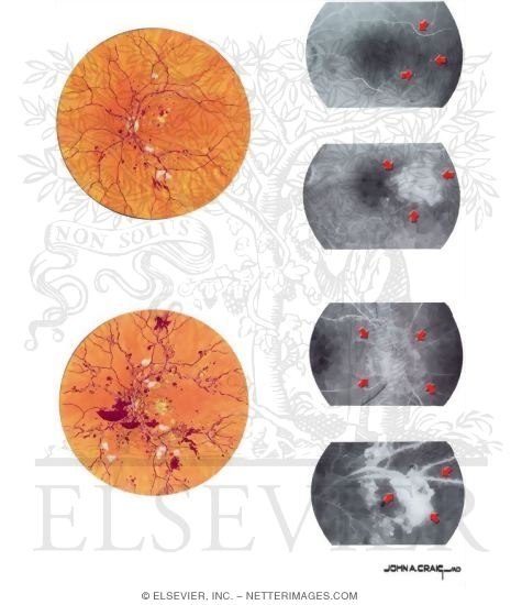 Watermarked preview of unlabeled image: Diabetic Retinopathy