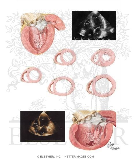 Left Ventricular Hypertrophy