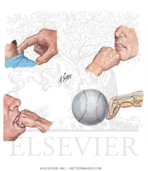 Jersey Finger
Boxer Fracture
Fight Bite
Mallet Finger