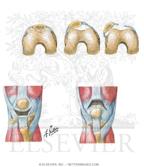Disorders of the Leg and Knee
Subluxation and Dislocation of Patella