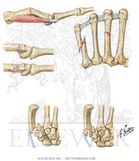 Watermarked preview of unlabeled image: Metacarpal Fractures
