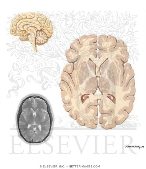 Head of Caudate and Midthalamus
