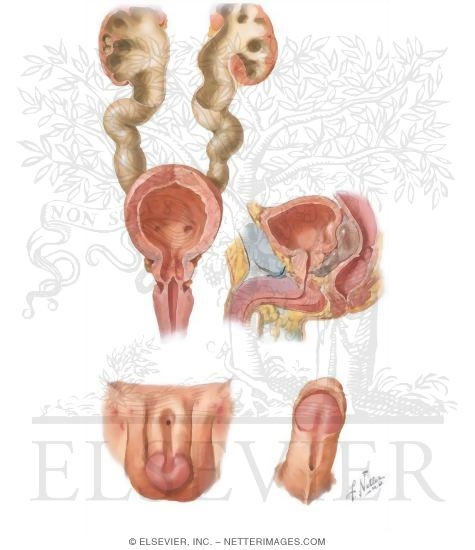 Congenital Anomalies: Congenital Valves, Epispadia, and Hypospadia