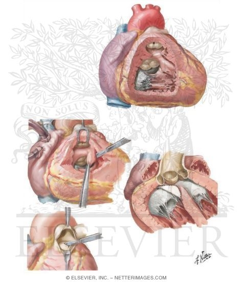 Watermarked preview of unlabeled image: Tetralogy of Fallot