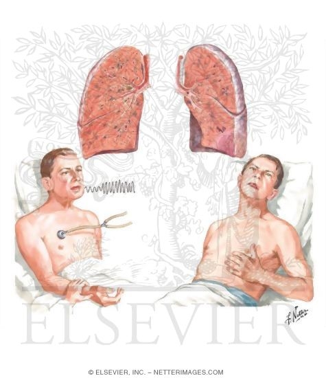 Pulmonary Embolism