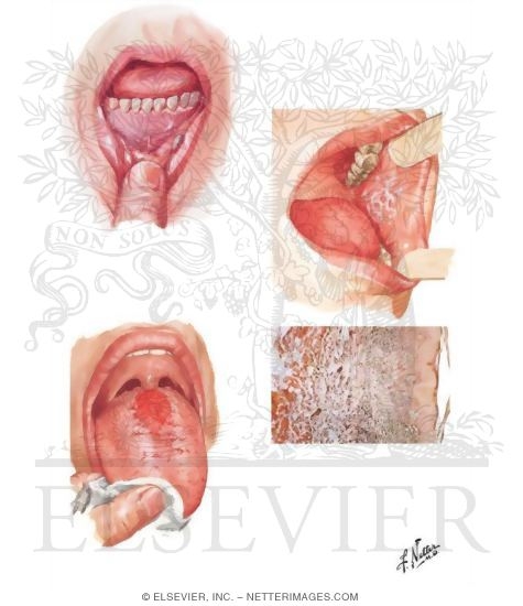 Common Oral Lesions