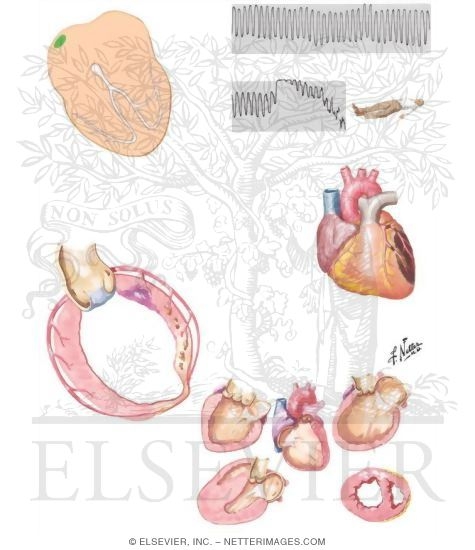 Watermarked preview of unlabeled image: Ventricular Tachycardia