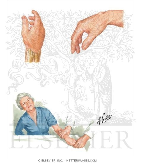 DeQuervain Disease
Ganglion Cyst
Finkelstein's Test
