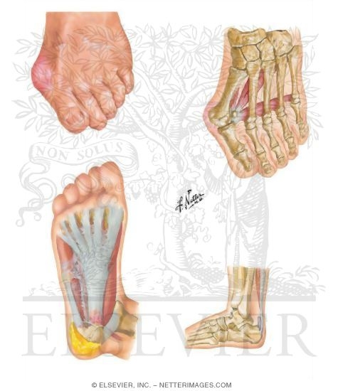 Disorders Of The Foot And Ankle - 