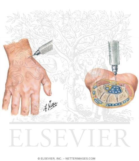 Aspiration of Wrist Joint