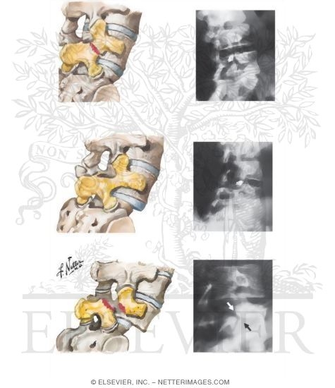 Spondylolysis and Spondylolisthesis