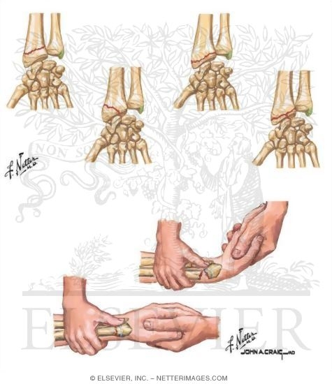 Frykman Classification of Fractures of Distal Radius
Reduction of a Colles Fracture