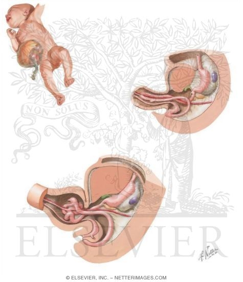 Watermarked preview of unlabeled image: Umbilical Hernia