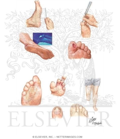Diabetes Mellitus and Its Complications: Neuropathy and Fungal Infection