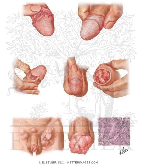 Watermarked preview of unlabeled image: Warts, Precancerous Lesions, and Cancer