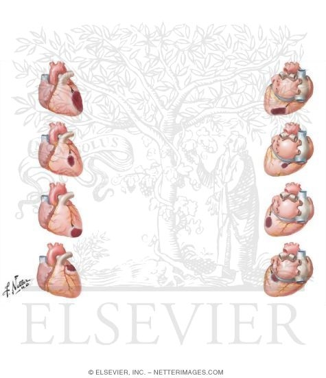 Watermarked preview of unlabeled image: Localization of Anterior and Posterior Infarcts
