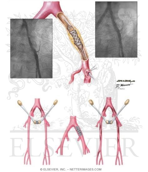 Watermarked preview of unlabeled image: Interventional Approaches to Peripheral Arterial Disease