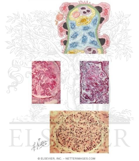 Watermarked preview of unlabeled image: Acute Glomerulonephritis