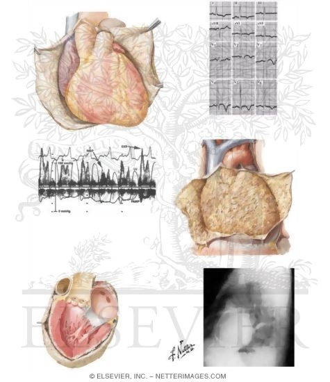 Watermarked preview of unlabeled image: Pericarditis