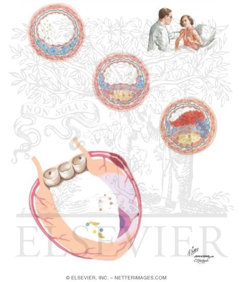 Watermarked preview of unlabeled image: Acute Coronary Syndromes