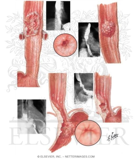 Watermarked preview of unlabeled image: Malignant Tumors of Midportion and Distal Portion of Esophagus