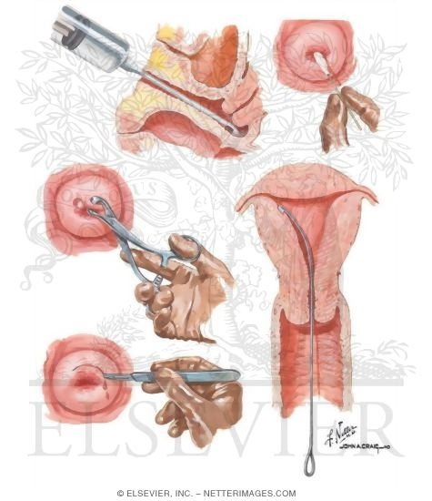 Postmenopausal Vaginal Bleeding Evaluation of Postmenopausal Bleeding