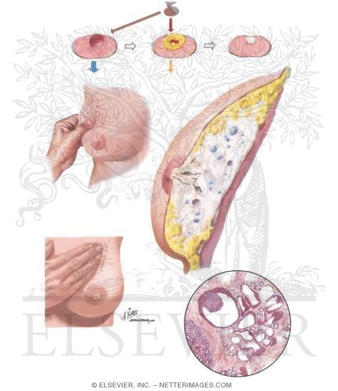 Breast: Fibrocystic Breast Change