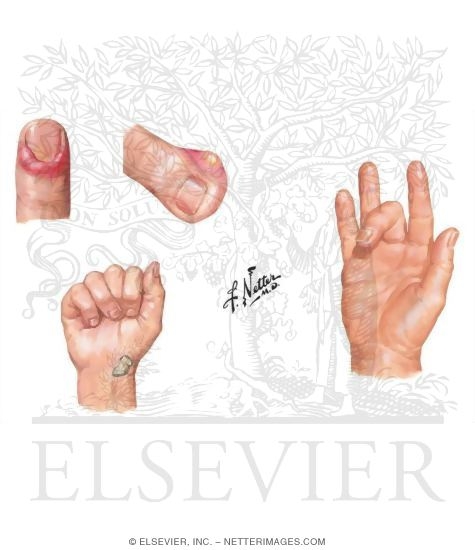 Watermarked preview of unlabeled image: Infections of the Fingers
Stenosing Tenosynovitis: Trigger Finger