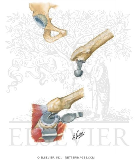 Watermarked preview of unlabeled image: Tips on Total Hips