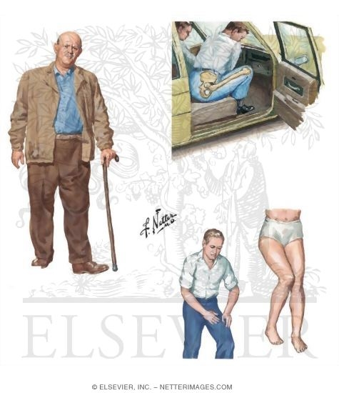 Watermarked preview of unlabeled image: History of Trauma to the Thigh and Hip