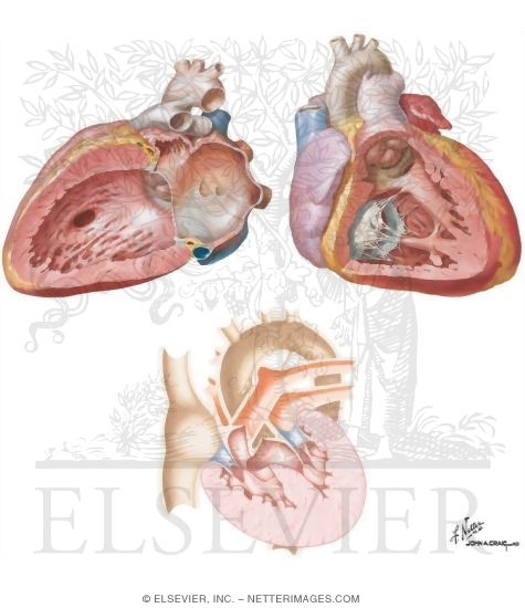 Watermarked preview of unlabeled image: Ventricular Septal Defects