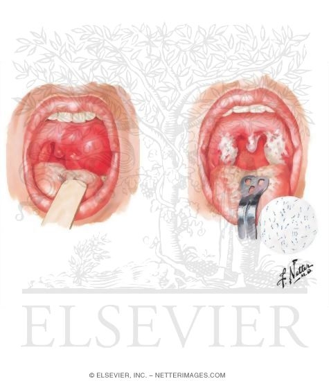 Watermarked preview of unlabeled image: Infections of Pharynx