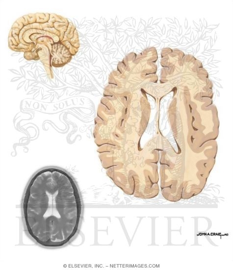 Dorsal Caudate, Splenium, and Genu of Corpus Callosum