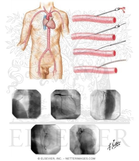 Left-Sided Heart Catheterization