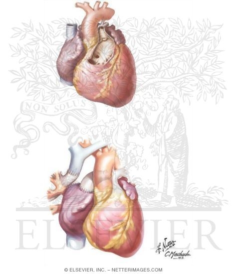 Tricuspid Atresia