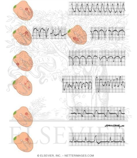 Ventricular Tachycardia (VT)