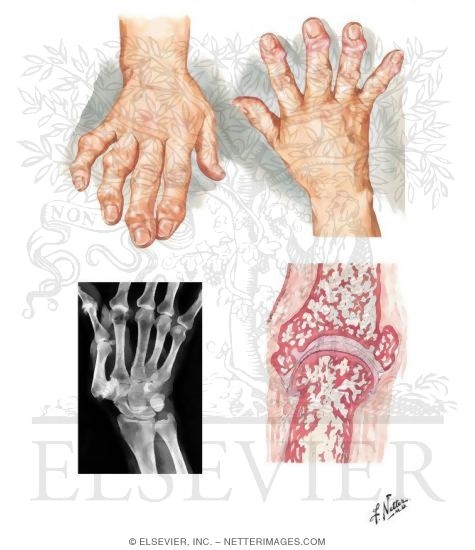 Hand Involvement In Osteoarthritis