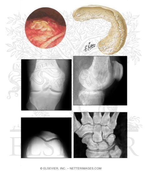 Articular Chondrocalcinosis (Pseudogout)