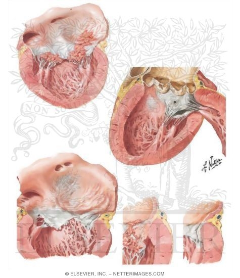Bacterial Endocarditis in Mitral Valvular Disease