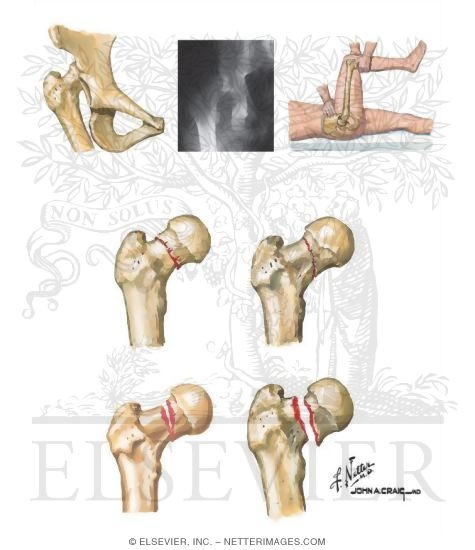 Watermarked preview of unlabeled image: Thigh and Hip Trauma