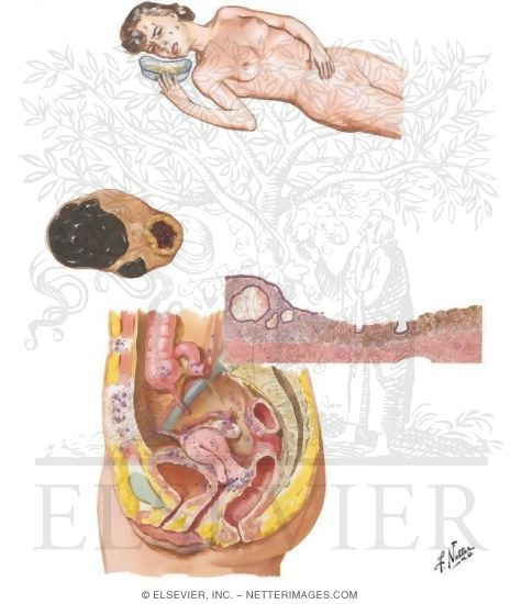 Dysmenorrhea: Primary and Secondary