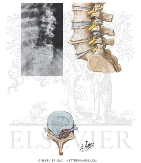 Degenerative Disc Disease