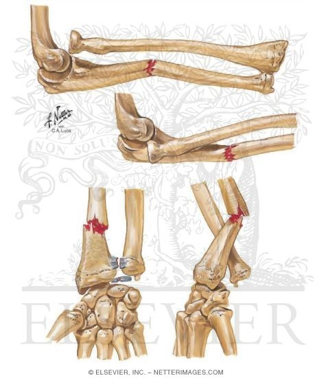 Monteggia Fracture
Galeazzi Fracture