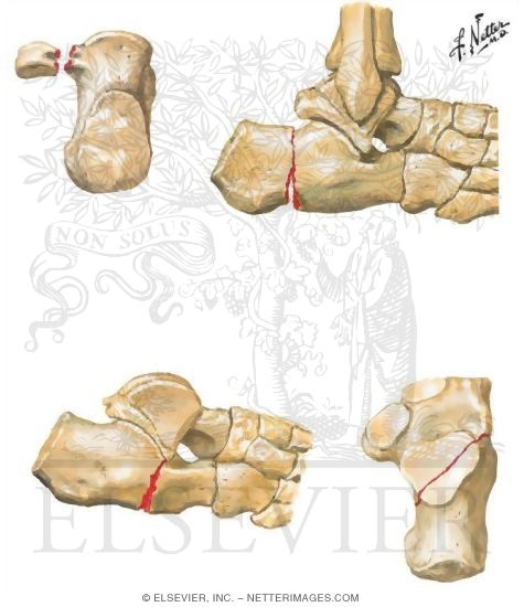 Watermarked preview of unlabeled image: Extraarticular Fracture of Calcaneus
Intraarticular Fracture of Calcaneus