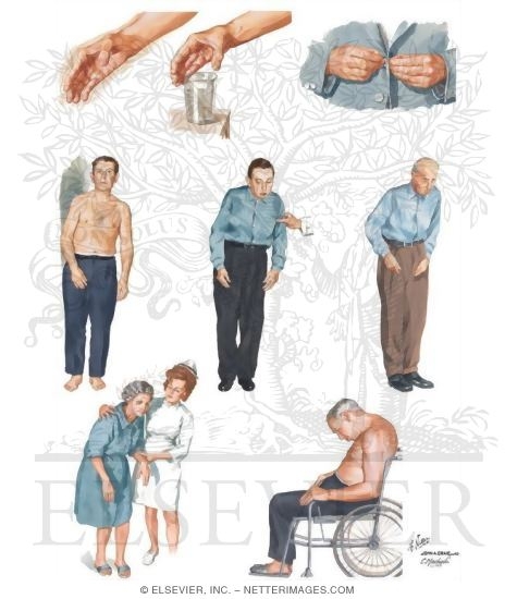 Parkinson's Disease