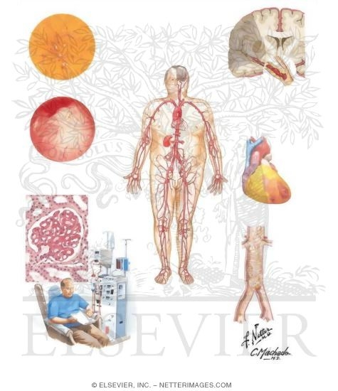 Diabetes Mellitus and Its Complications: Micro and Diabetes Mellitus and Its Complications: Micro and